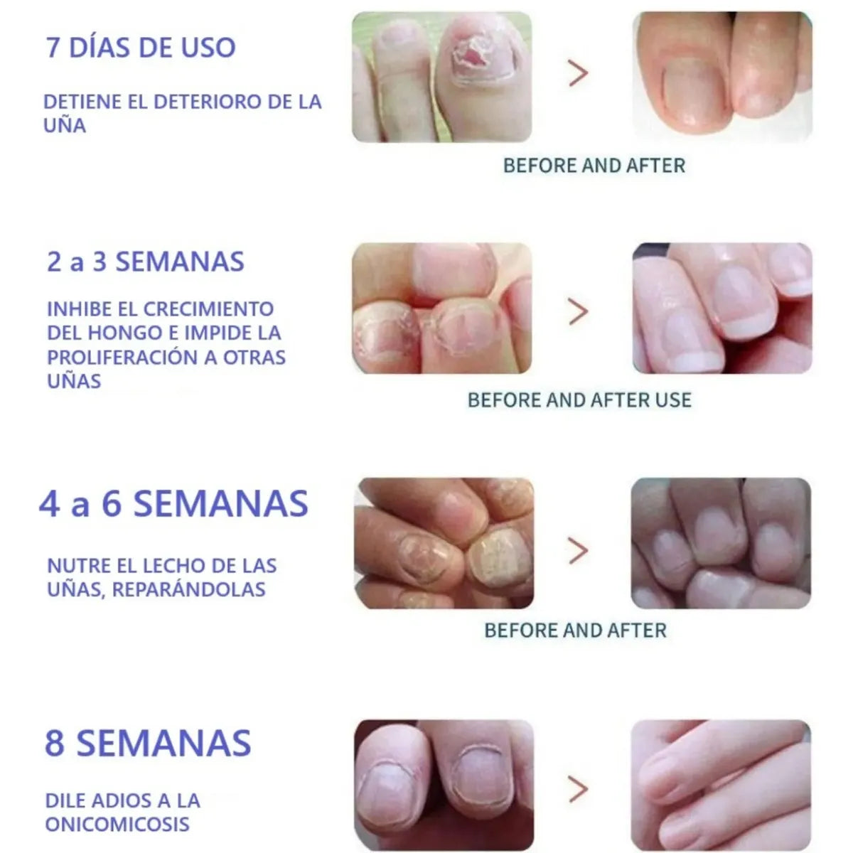 16 Parches Tratamiento Hongo Uñas